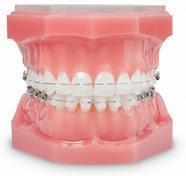 Mi nuevo tratamiento de ortodoncia estética Damon Clear®