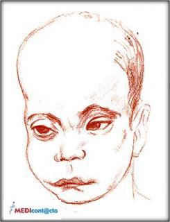 El Síndrome de Lowe.