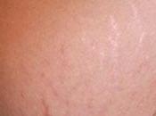 Estrias despues embarazo