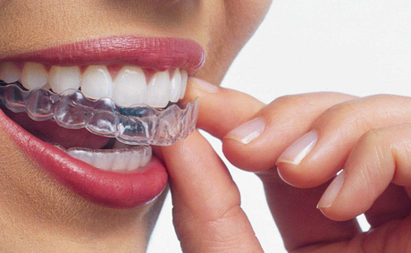 Ortodoncia Invisible en Mirasierra