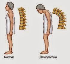 Tratamiento para la Osteoporosis