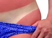 Tratamiento Sabila para quemaduras