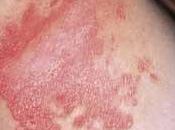 Tratamiento Sabila para Psoriasis