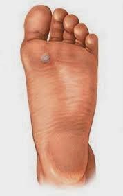 Como quitar verrugas