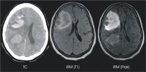 Porque me importa, actúa contra el ictus. Por ti, por los tuyos