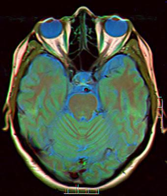 Larga permanencia en el espacio afecta los ojos y el cerebro astronautas