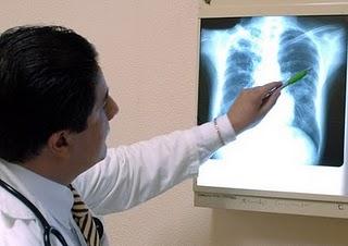 Realiza IMSS programa preventivo para combatir tuberculosis