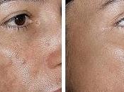 Como eliminar aclarar manchas rostro