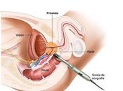 Diagnóstico prevención cáncer próstata: aspectos prácticos para médico familia.