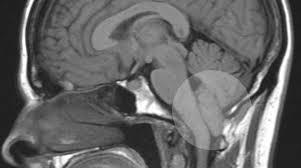Las Malformaciónes de Chiari
