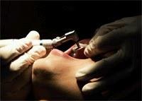 Las radiografías de los dientes permitirían identificar el riesgo de sufrir fracturas Las radiografías de los dientes permitirían identificar el riesgo de sufrir fracturas