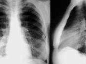 posible diagnosticar neumonía radiografía?