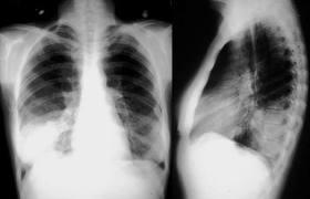 ¿Es posible diagnosticar la neumonía sin radiografía?