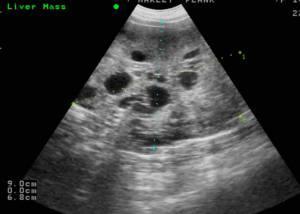 Descubierta un mecanismo que induce a la migración de células cancerosas liver_tumor1
