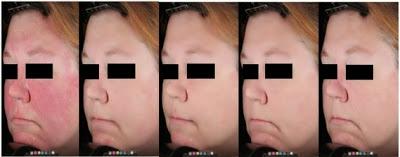 ROSACEA: NUEVOS TRATAMIENTOS