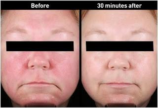 ROSACEA: NUEVOS TRATAMIENTOS