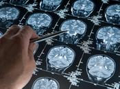 Científicos sugieren tecnología láser podrá curar Alzheimer