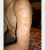 La figura de Lichtenberg, el tatuaje gratuito del rayo