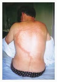 La figura de Lichtenberg, el tatuaje gratuito del rayo