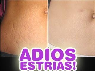 COMO ELIMINAR LAS ESTRIAS COMO ELIMINAR LAS ESTRIAS