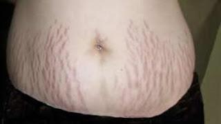 COMO ELIMINAR LAS ESTRIAS COMO ELIMINAR LAS ESTRIAS