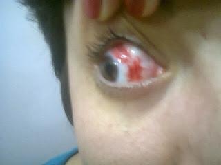 SE ME EXPLOTÓ EL OJO!