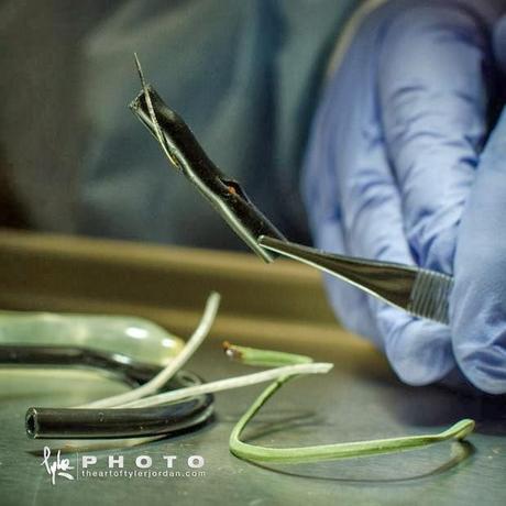 Objetos extraidos del pene de una persona por un Urologo