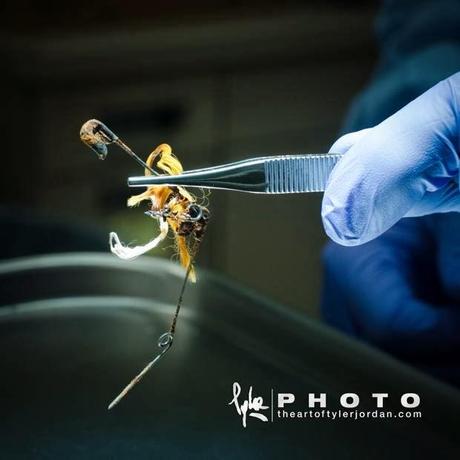 Objetos extraidos del pene de una persona por un Urologo