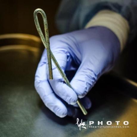 Objetos extraidos del pene de una persona por un Urologo