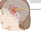 María Villota murió Aneurisma. ¿Qué produce?