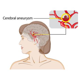 Cerebral aneurysm