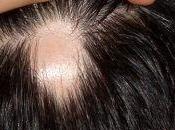 estrés, enemigo para salud nuestro cabello