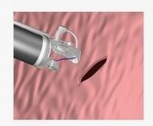 Método Apollo para tratar la obesidad