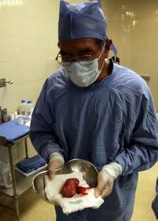 De manera inédita un Hospital de Segundo Nivel del IMSS realiza 100 trasplantes de riñón