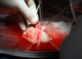 De manera inédita un Hospital de Segundo Nivel del IMSS realiza 100 trasplantes de riñón