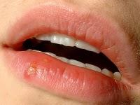 ☻Prohibido besar si tienes un brote de Herpes Labial.