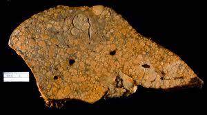 1er Conmemoración Mundial del Día contra las hepatitis virales