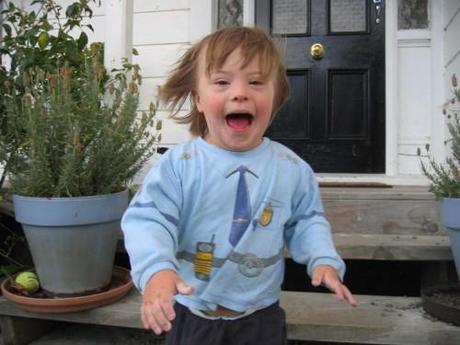 Síndrome de Down Síndrome de Down