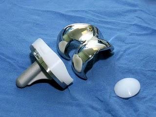 IMSS brinda atención de calidad en cirugía de sustitución de cadera y rodilla