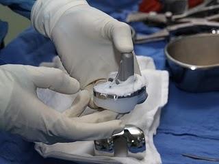 IMSS brinda atención de calidad en cirugía de sustitución de cadera y rodilla