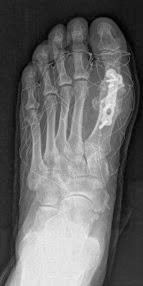 OTRO CASO DE HALLUX RIGIDUS