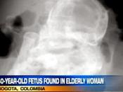 Mujer años descubre llevaba "embarazada"