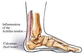 tendon2 Tendón de Aquiles, un arma de doble filo para los corredores y atletas