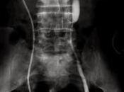 Historia amiga Fibrosis Retroperitoneal veces portadora catéter doble