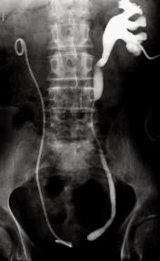 Historia de una amiga con Fibrosis Retroperitoneal (30 veces portadora de catéter doble J)