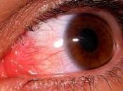 Recomendaciones aparición pequeños Derrames Oculares