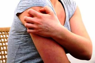 Remedios naturales para la urticaria