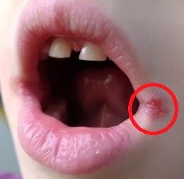 ODONTOPOST: queilitis