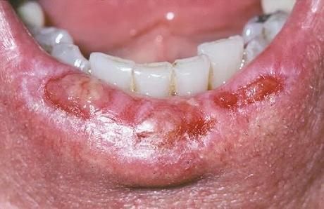 ODONTOPOST: queilitis