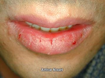 ODONTOPOST: queilitis